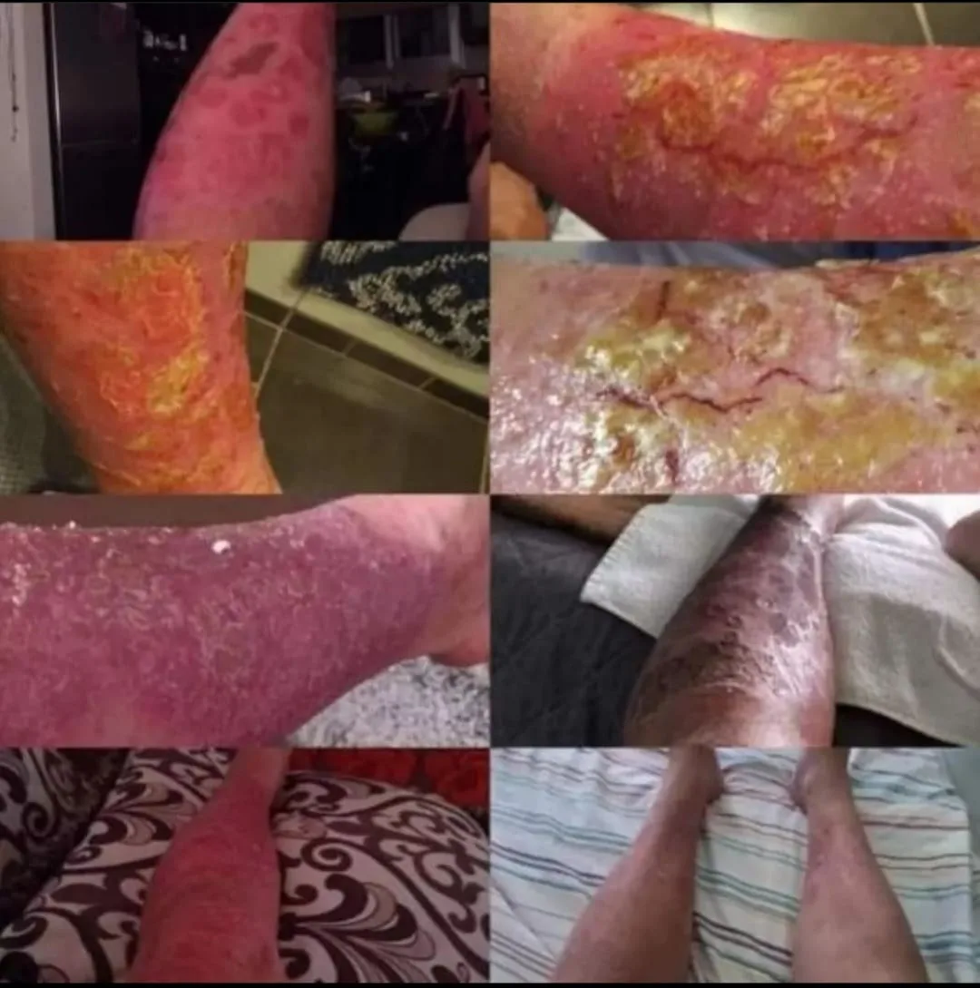 Collage of photos showing red, scaly and crusted skin on arms and legs